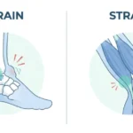 sprain or strain